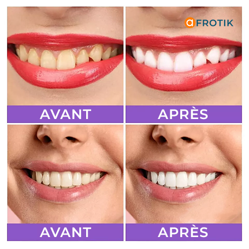 MOUSSE BLANCHISSSEUSE DES DENTS LANTHOME V34 : LE SECRET POUR RETROUVER SON SOURIRE ECLATANT